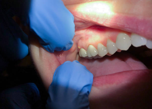 Best Emergency Treatment for Dental Infections or Abscesses in Oatfield, OR